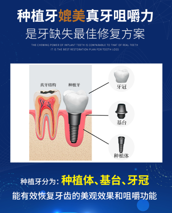 建议收藏！科普种植牙全过程