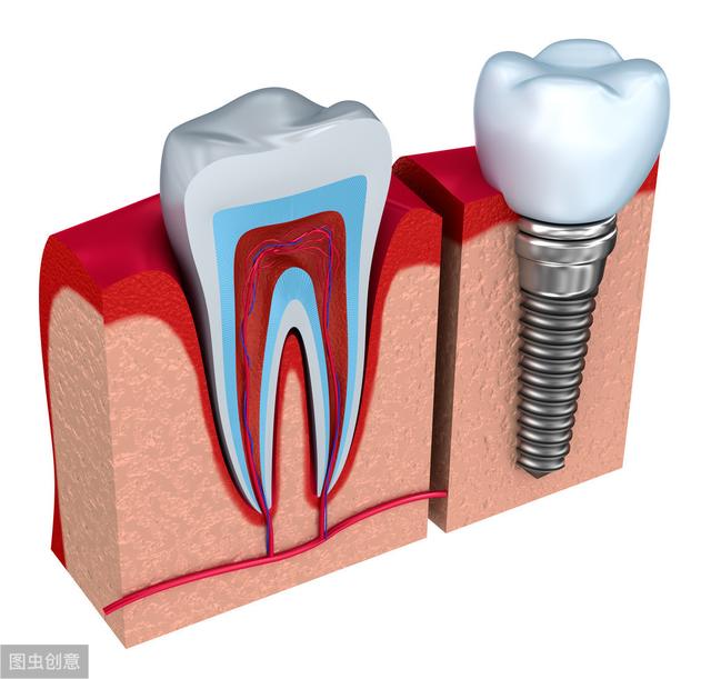 种植体与天然牙的区别