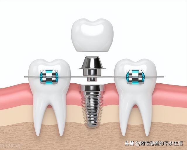 做了一颗种植牙