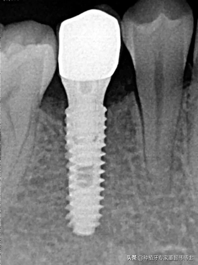 案例分享：后牙拔牙+即刻种植+延期修复