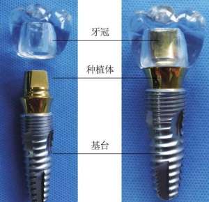 上海医院种植牙价格表(“种口牙相当一辆宝马、县城一套房”？国家要出手了)