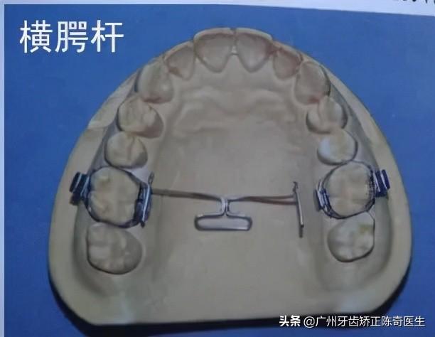 4颗骨钉解决严重骨性前突+露龈笑~别看骨钉小，作用还挺大