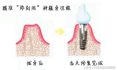 很多人对手术都有怕疼的恐惧！那么种植牙疼不疼？