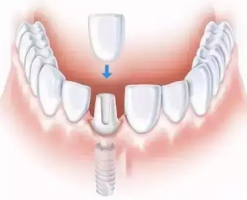 种植牙“二期”手术究竟是什么意思？
