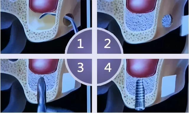 老年人牙槽骨萎缩，不能种牙？这一个办法可以拯救