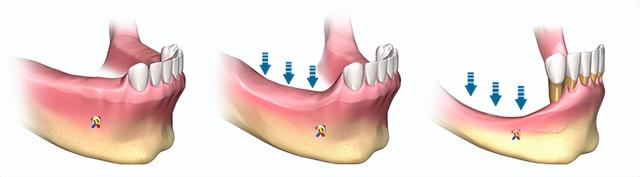 种植牙竟然还要填几千块的骨粉？这怕不又是个“收费套路”吧
