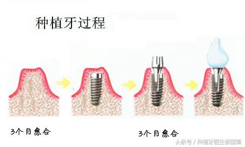 很多人对手术都有怕疼的恐惧！那么种植牙疼不疼？