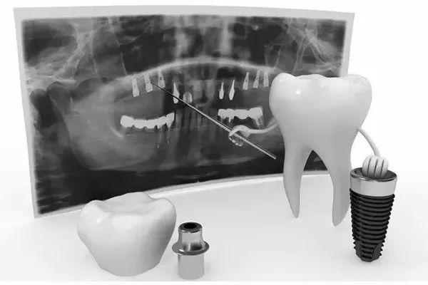 想种牙，必须做足这些“功课”你知道吗？