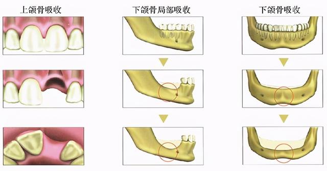 老年人牙槽骨萎缩，不能种牙？这一个办法可以拯救