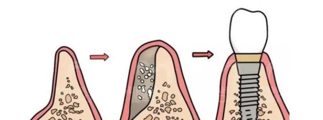 老年人牙槽骨萎缩，不能种牙？这一个办法可以拯救