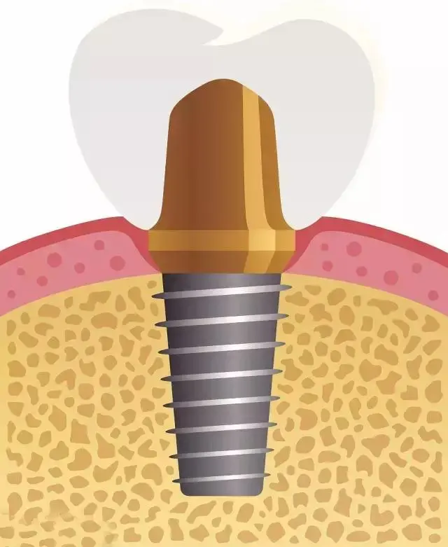 种植牙“二期”手术究竟是什么意思？