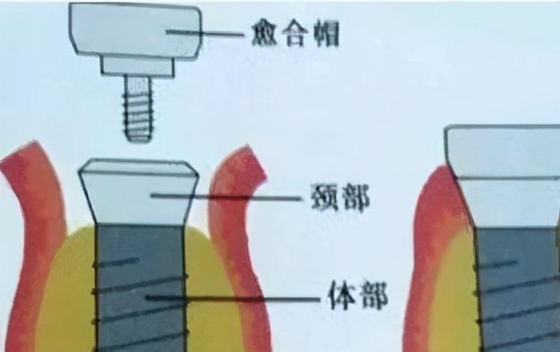 口腔科普：种植牙区别#雅悦齿科#