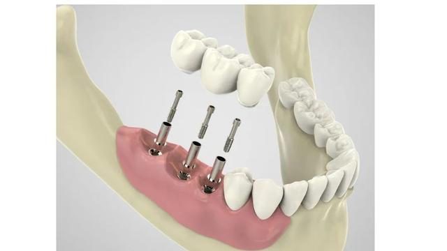 种植牙终于告别“万元一颗”？你有这个计划吗