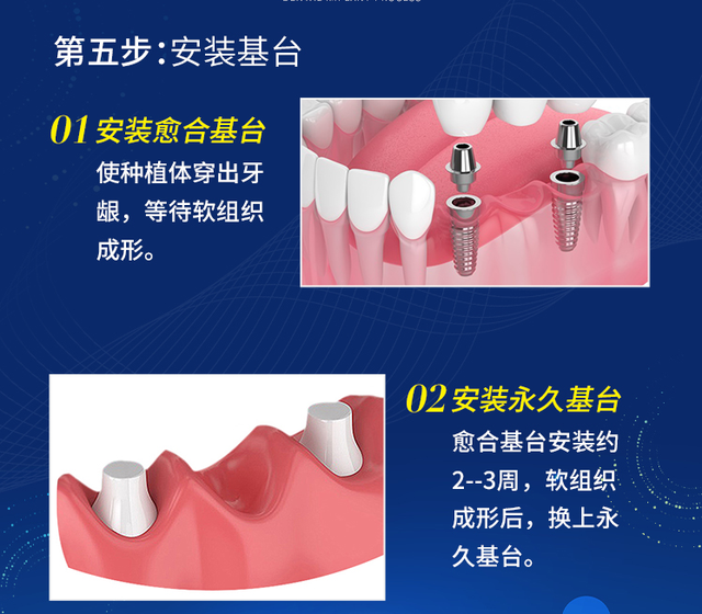 建议收藏！科普种植牙全过程