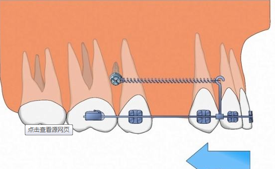 牙齿矫正还要打骨钉？直接打钉子进牙龈不疼吗？牙医为你解秘