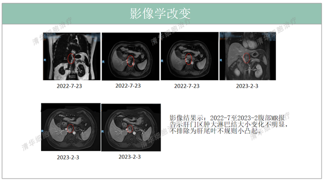 结肠癌术后不到一年两次肝转移，该如何扭转局面？