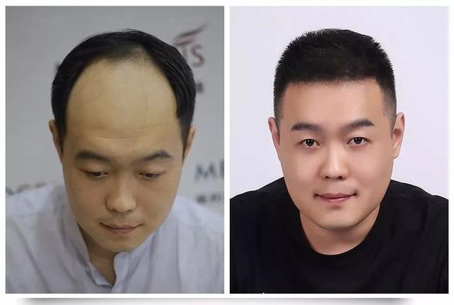 哈尔滨小伙4小时终结12年脱发！果然……每个秃顶都是潜力股