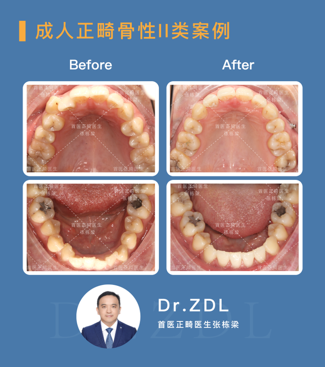 骨性龅牙选择正畸还是正颌手术？