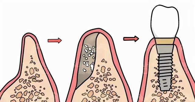 满足这些条件，年龄再高也能种牙