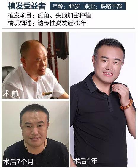 哈尔滨小伙4小时终结12年脱发！果然……每个秃顶都是潜力股