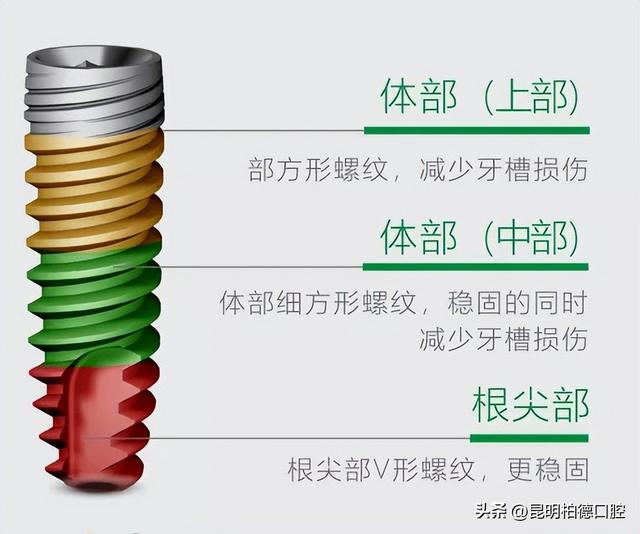 种植体如何选？3款主流德国种植系统详细解读来了