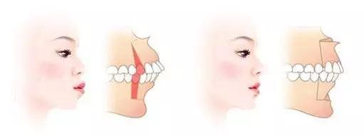 骨性龅牙选择正畸还是正颌手术？