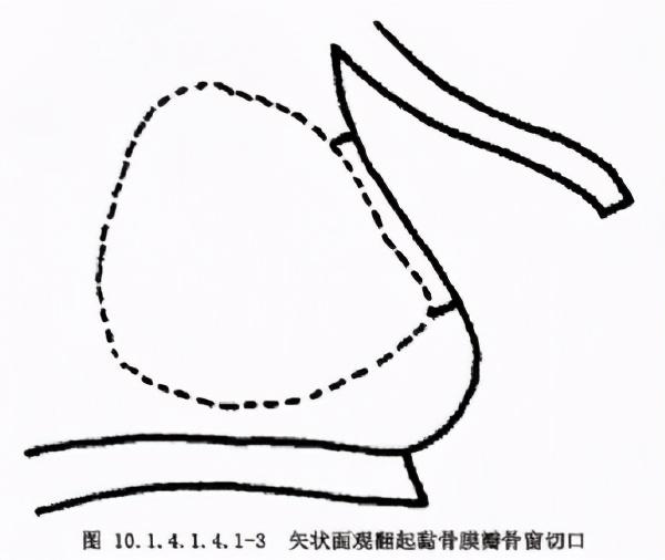 庄龙飞：什么是上颌窦提升术？上颌窦提升术的流程步骤是怎样的？