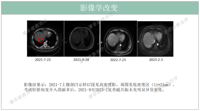 结肠癌术后不到一年两次肝转移，该如何扭转局面？