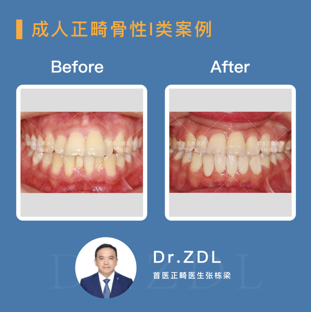 骨性龅牙选择正畸还是正颌手术？