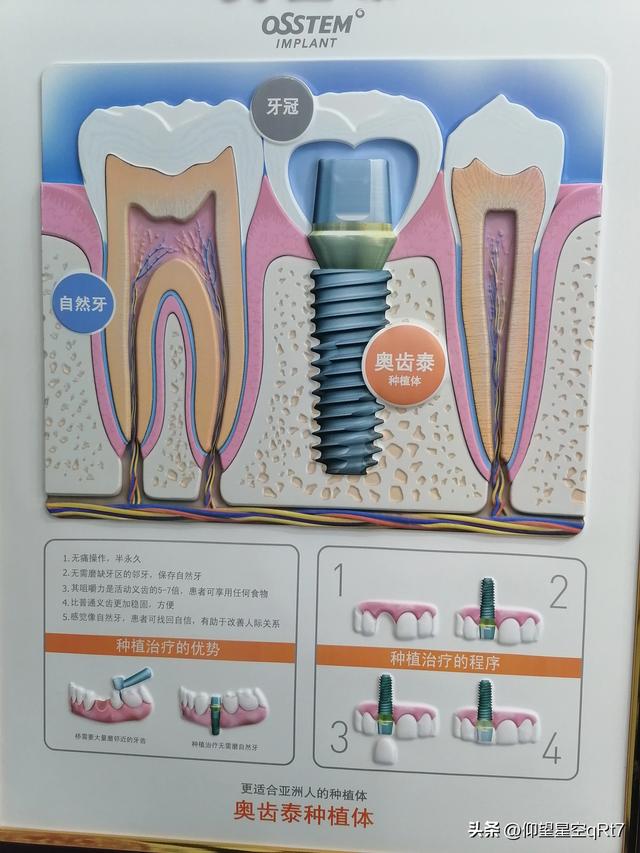 在私立齿科做种植牙的感受