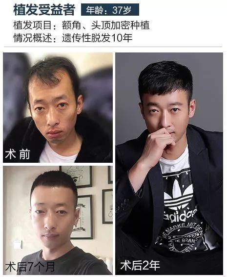 哈尔滨小伙4小时终结12年脱发！果然……每个秃顶都是潜力股