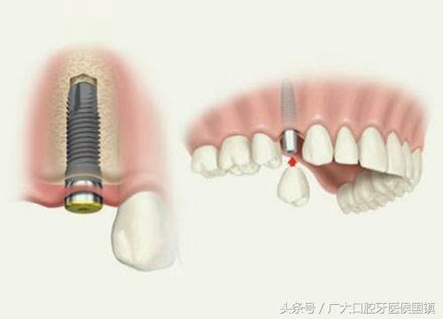 种植牙出现这个现象，说明炎症已形成，再不注意就破坏骨床了