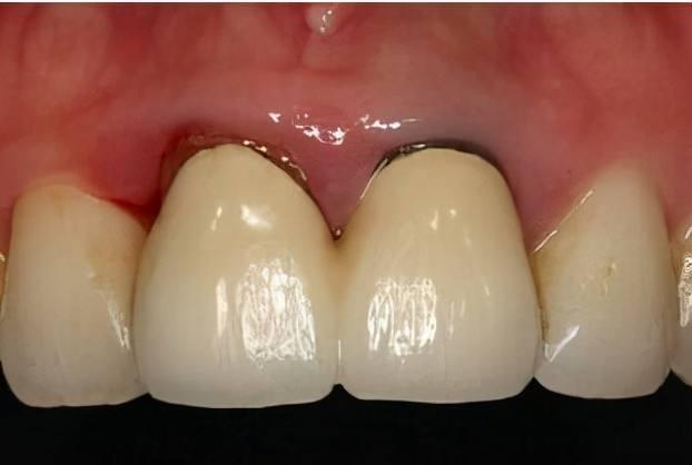 为什么做牙冠的时候建议做全瓷材料？关键时刻能救命