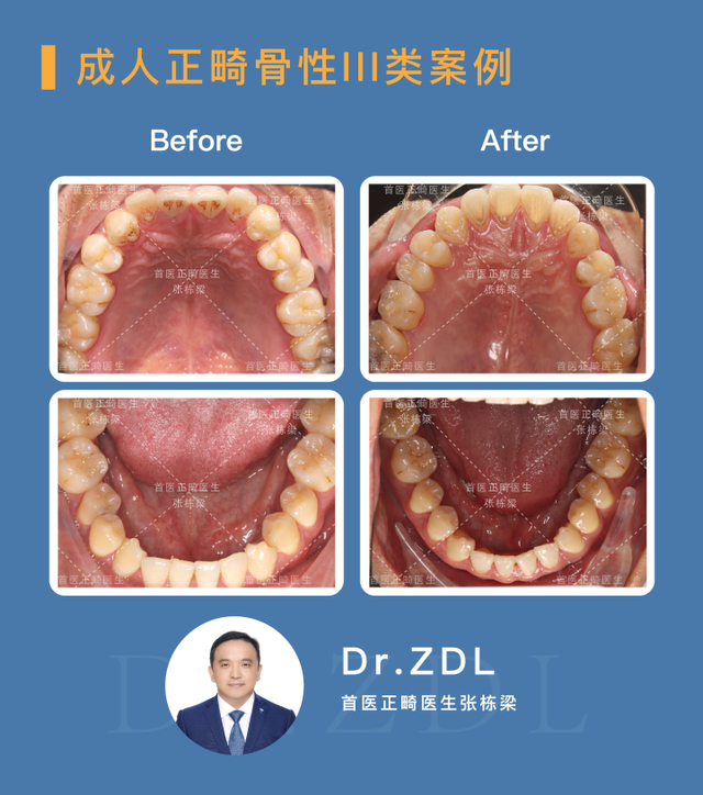 骨性龅牙选择正畸还是正颌手术？