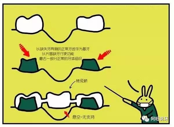 一分钟带你了解种植牙，以下漫画看完就懂！