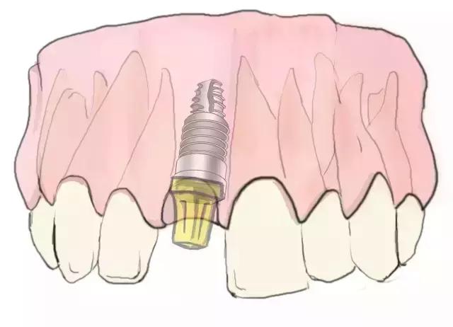 简单明了的种植牙介绍！（图）