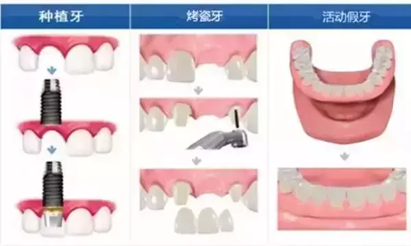 种植牙跟镶牙，哪个更胜一筹？