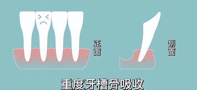 牙槽骨吸收是怎么回事？该怎么办？