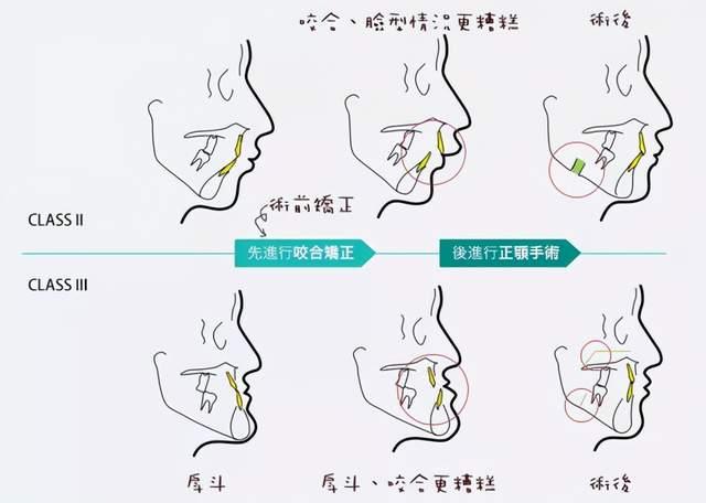 骨性龅牙选择正畸还是正颌手术？