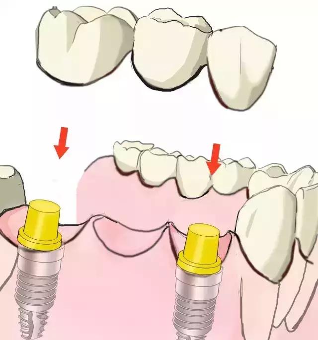 简单明了的种植牙介绍！（图）