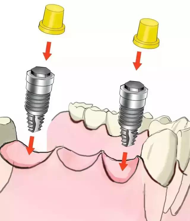 简单明了的种植牙介绍！（图）
