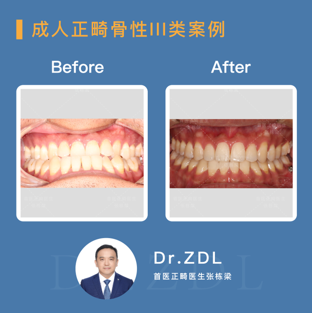 骨性龅牙选择正畸还是正颌手术？