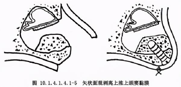 庄龙飞：什么是上颌窦提升术？上颌窦提升术的流程步骤是怎样的？