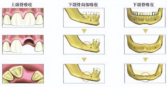 牙槽骨吸收是怎么回事？该怎么办？