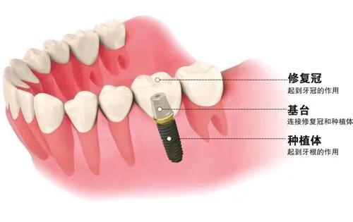 种植牙的4S标准，你知道吗？？