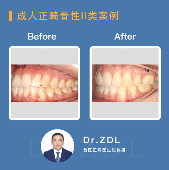 骨性龅牙选择正畸还是正颌手术？