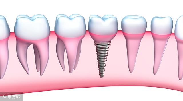 “人类的第三副牙齿”——种植牙