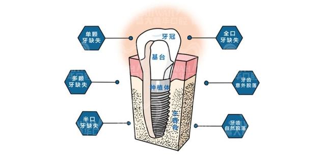 全口种植牙比吸附性义齿和活动假牙好吗？