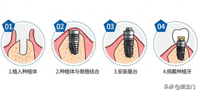 第一次种牙，你一定要知道的几个关键问题！