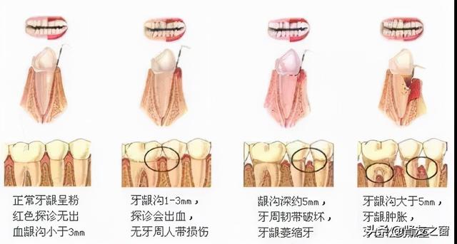 糖尿病与人工种植牙